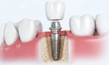 Cắm Implant